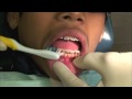 My New Braces